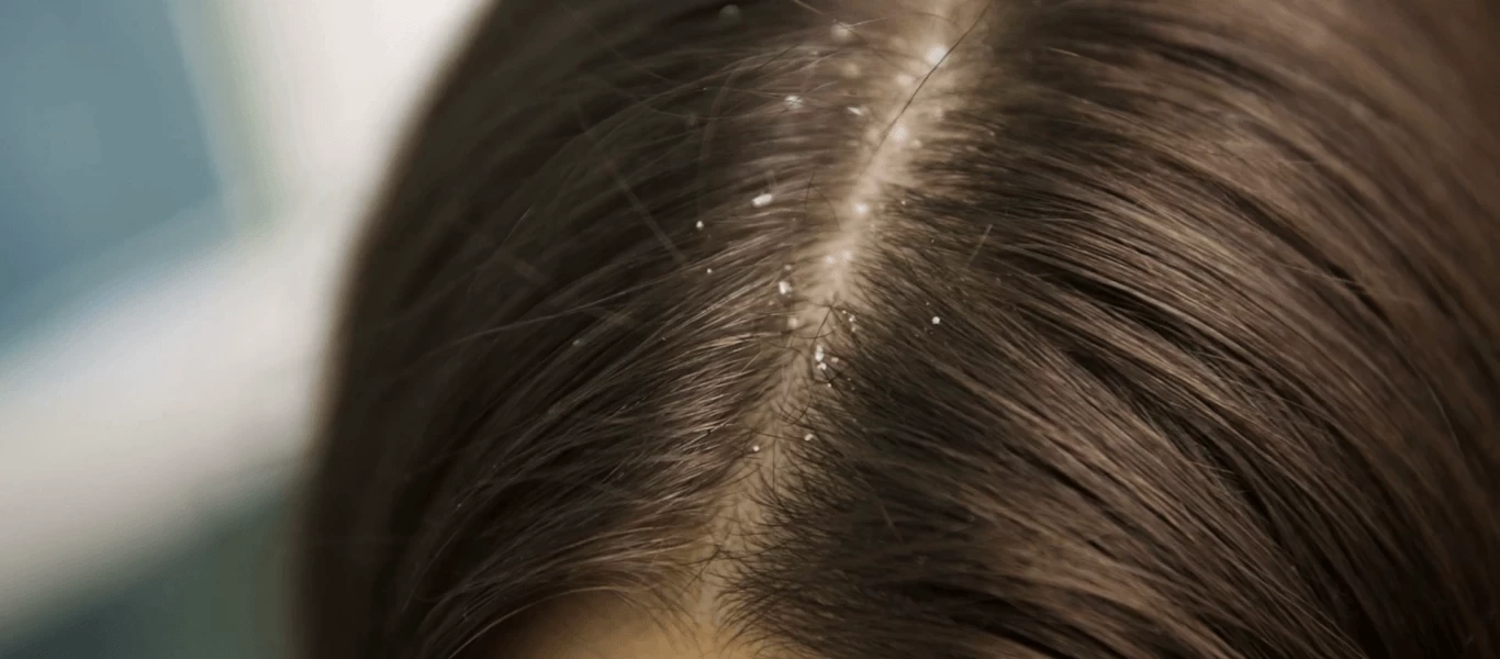 Άσπρες νιφάδες στα μαλλιά: Πότε είναι πιτυρίδα και πότε ξηροδερμία; - Ιδού η απάντηση